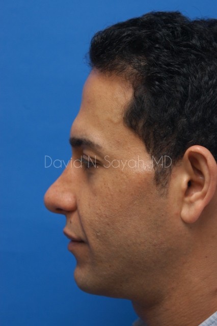 Rhinoplasty Before and After | Sayah Institute
