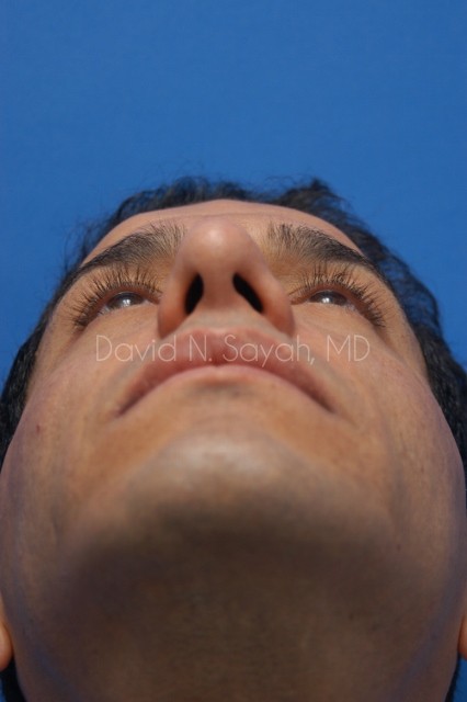 Rhinoplasty Before and After | Sayah Institute