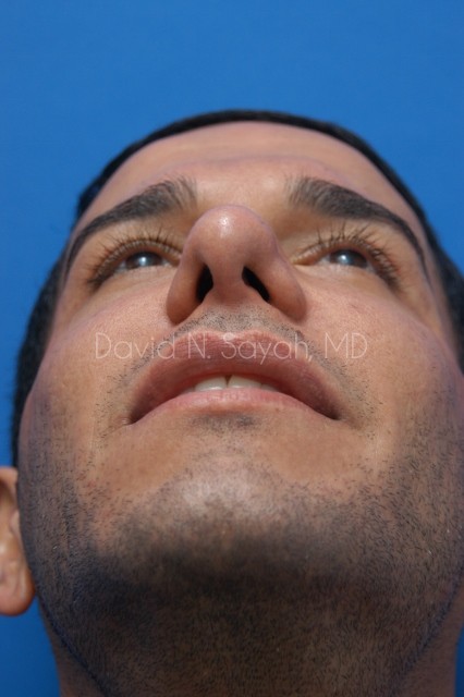 Rhinoplasty Before and After | Sayah Institute