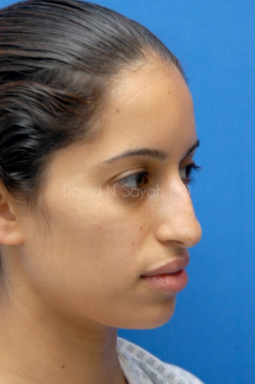 Rhinoplasty Before and After | Sayah Institute