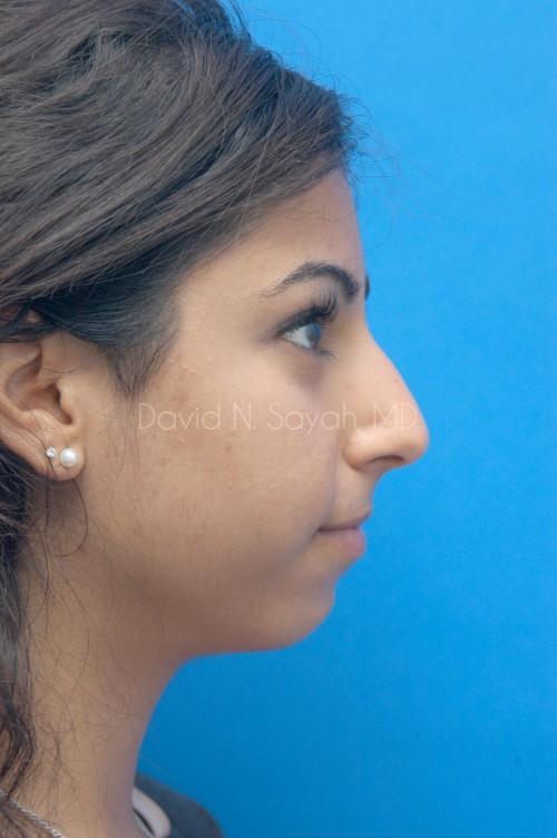 Rhinoplasty Before and After | Sayah Institute