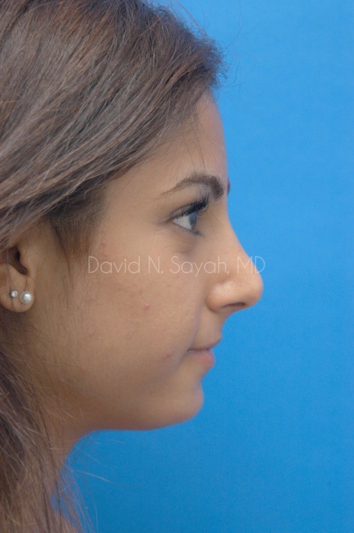Rhinoplasty Before and After | Sayah Institute