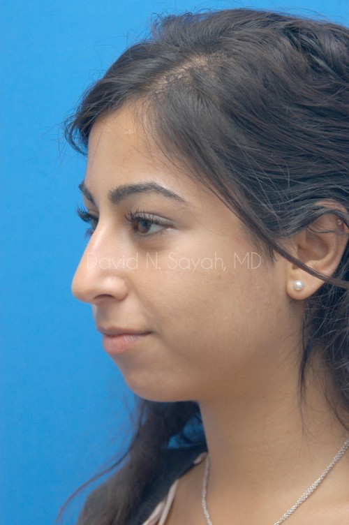 Rhinoplasty Before and After | Sayah Institute