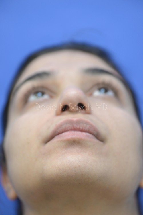 Rhinoplasty Before and After | Sayah Institute