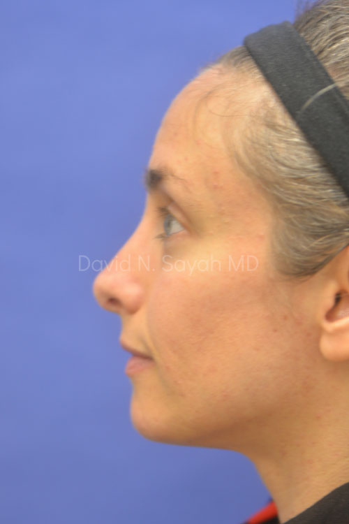 Rhinoplasty Before and After | Sayah Institute