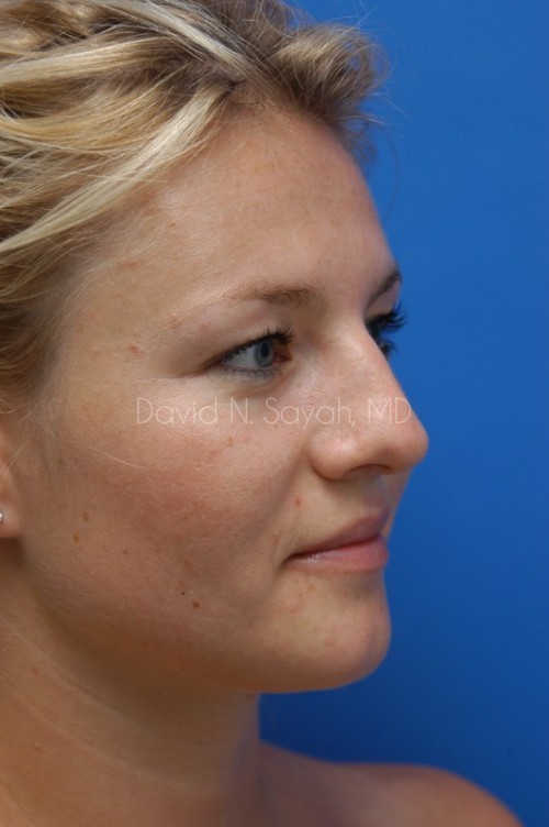 Rhinoplasty Before and After | Sayah Institute