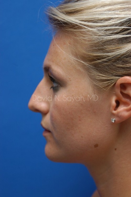 Rhinoplasty Before and After | Sayah Institute