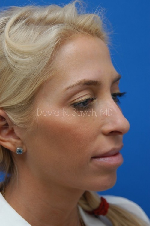 Rhinoplasty Before and After | Sayah Institute
