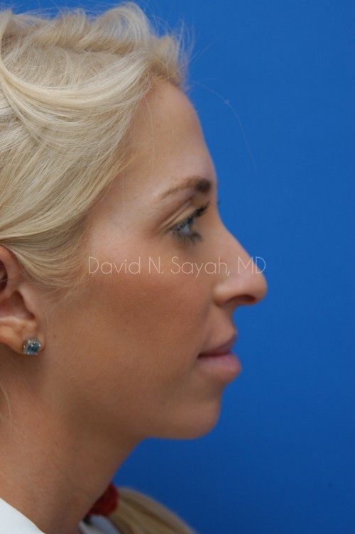 Rhinoplasty Before and After | Sayah Institute
