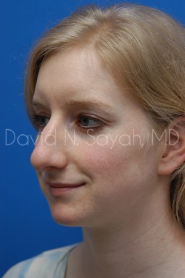 Rhinoplasty Before and After | Sayah Institute