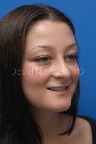 Rhinoplasty Before and After | Sayah Institute