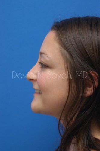 Rhinoplasty Before and After | Sayah Institute