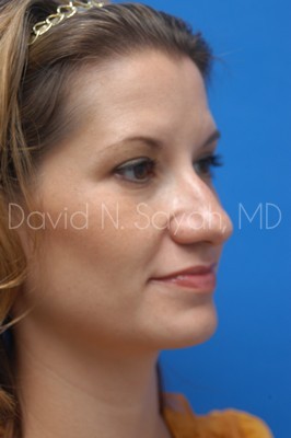 Rhinoplasty Before and After | Sayah Institute