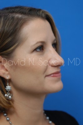 Rhinoplasty Before and After | Sayah Institute