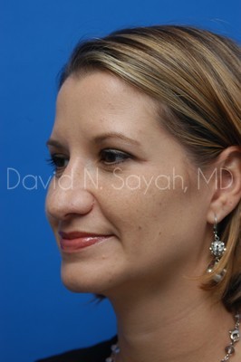 Rhinoplasty Before and After | Sayah Institute