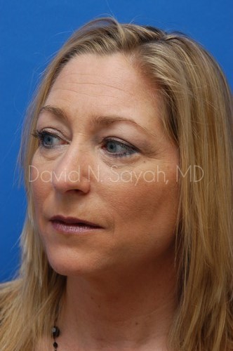 Rhinoplasty Before and After | Sayah Institute