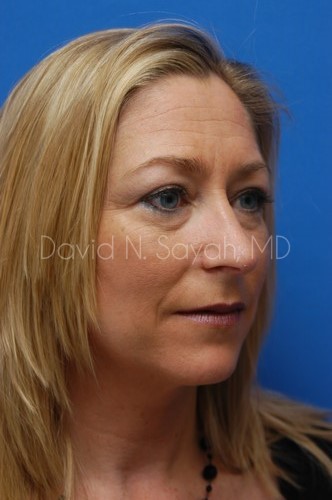 Rhinoplasty Before and After | Sayah Institute