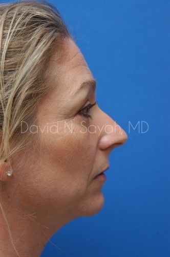 Rhinoplasty Before and After | Sayah Institute