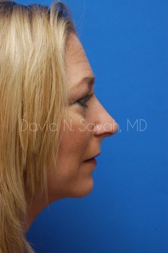 Rhinoplasty Before and After | Sayah Institute