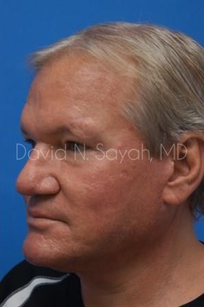Rhinoplasty Before and After | Sayah Institute