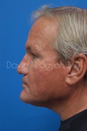 Rhinoplasty Before and After | Sayah Institute
