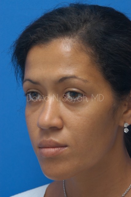 Rhinoplasty Before and After | Sayah Institute