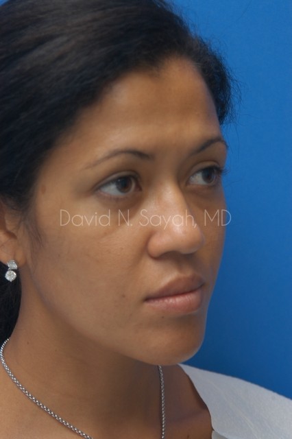 Rhinoplasty Before and After | Sayah Institute