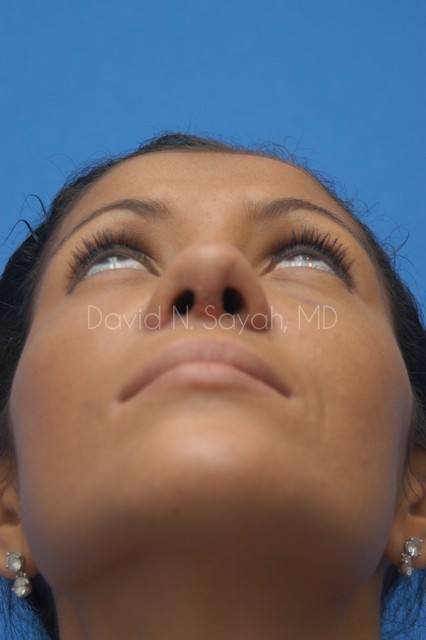 Rhinoplasty Before and After | Sayah Institute