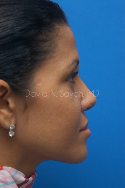 Rhinoplasty Before and After | Sayah Institute