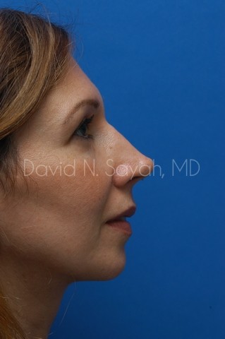 Rhinoplasty Before and After | Sayah Institute