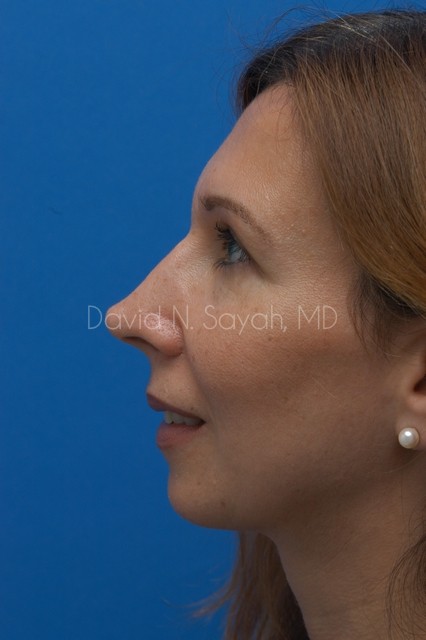 Rhinoplasty Before and After | Sayah Institute