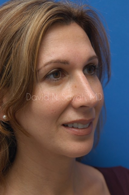 Rhinoplasty Before and After | Sayah Institute
