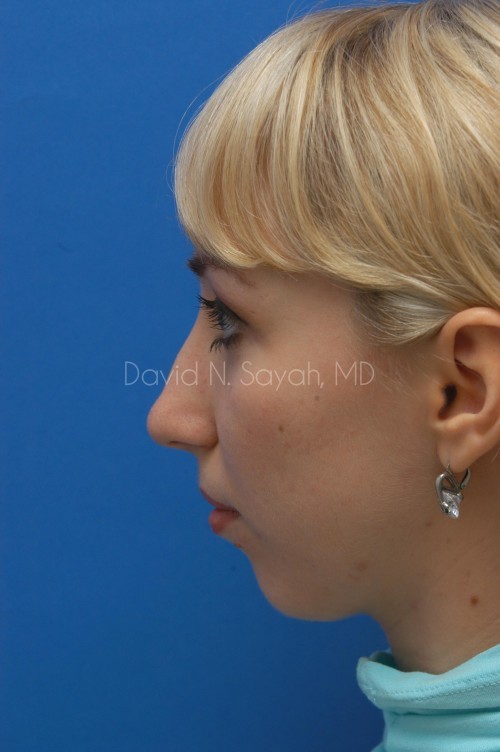 Rhinoplasty Before and After | Sayah Institute