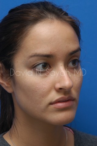 Rhinoplasty Before and After | Sayah Institute
