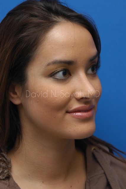 Rhinoplasty Before and After | Sayah Institute