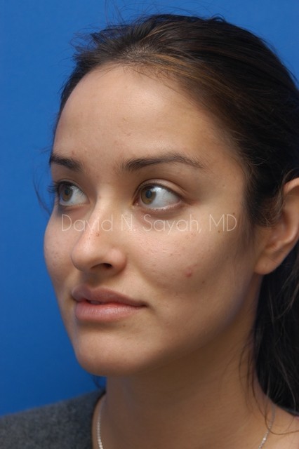Rhinoplasty Before and After | Sayah Institute