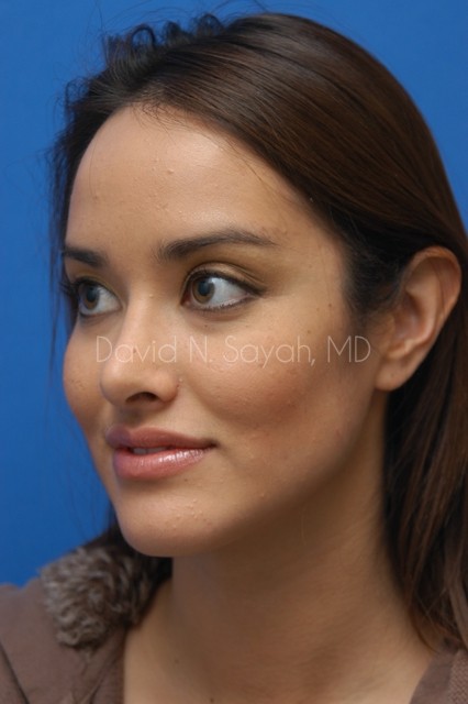 Rhinoplasty Before and After | Sayah Institute