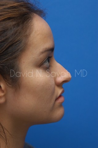Rhinoplasty Before and After | Sayah Institute