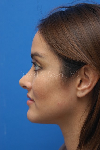 Rhinoplasty Before and After | Sayah Institute