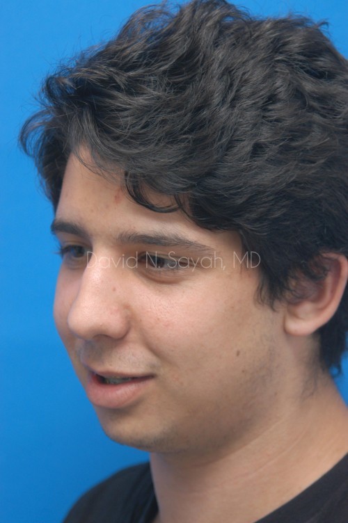 Rhinoplasty Before and After | Sayah Institute