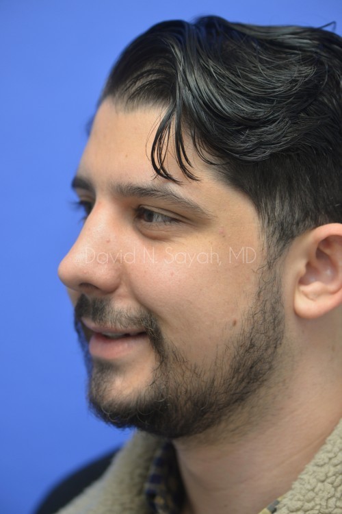Rhinoplasty Before and After | Sayah Institute