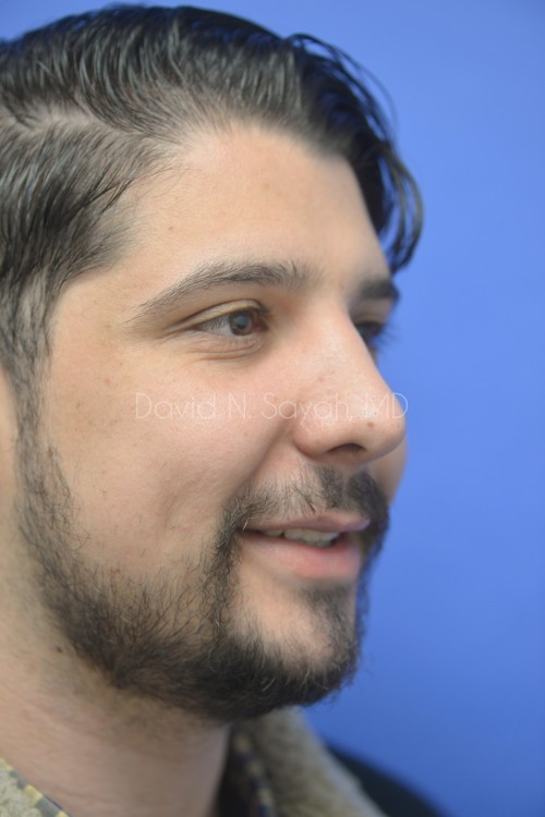 Rhinoplasty Before and After | Sayah Institute