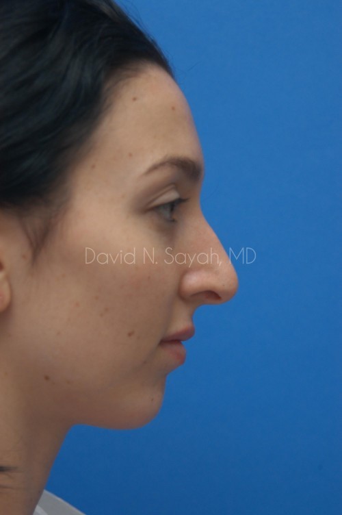 Rhinoplasty Before and After | Sayah Institute