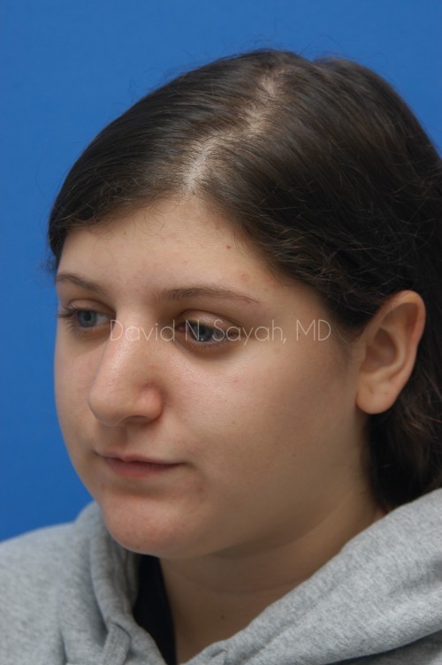 Rhinoplasty Before and After | Sayah Institute