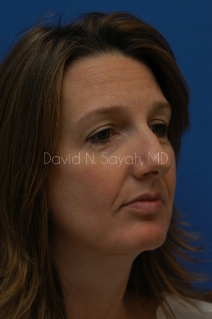 Rhinoplasty Before and After | Sayah Institute