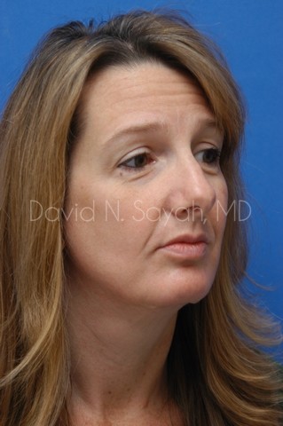 Rhinoplasty Before and After | Sayah Institute