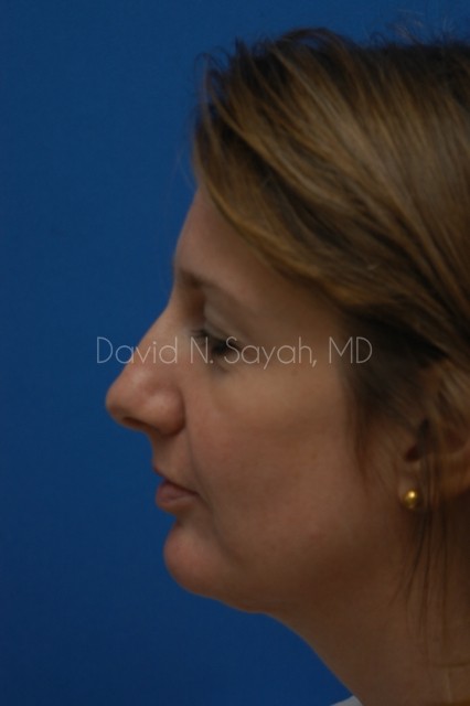Rhinoplasty Before and After | Sayah Institute