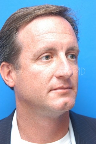 Rhinoplasty Before and After | Sayah Institute