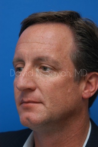 Rhinoplasty Before and After | Sayah Institute