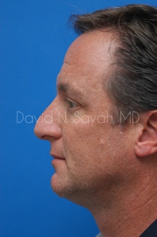 Rhinoplasty Before and After | Sayah Institute